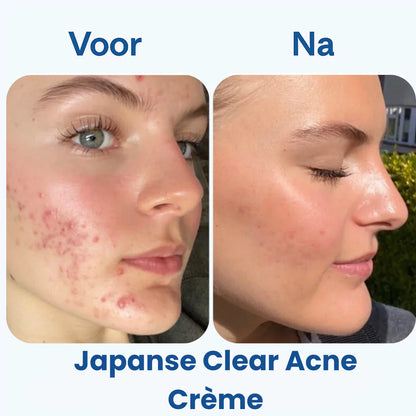 Japanese Clear Acne Cream 24g